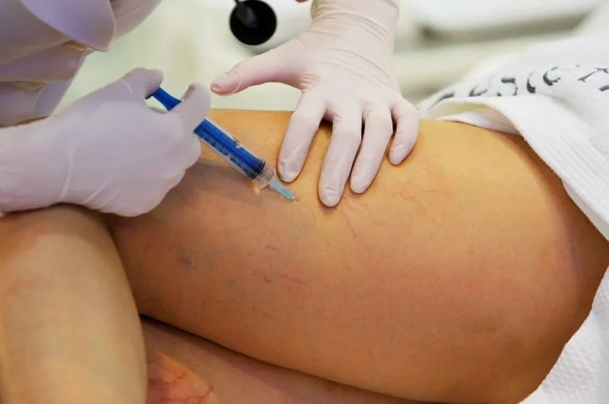 Escleroterapia ampliada