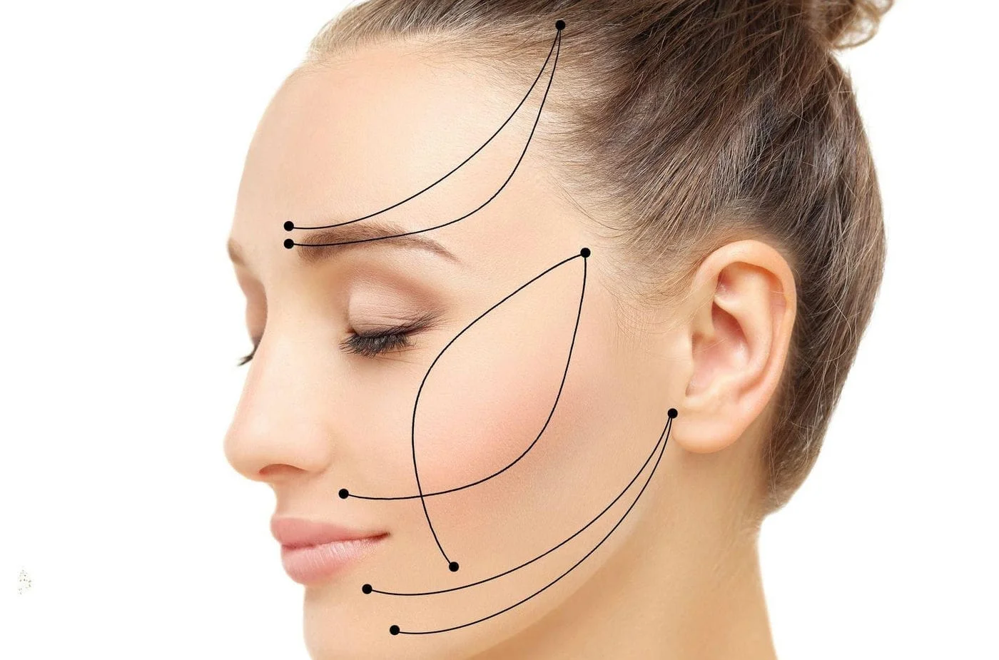 Entenda como funcionam os Fios de Sustentação