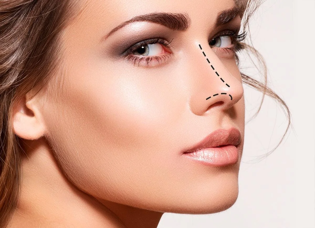 Rinomodelação com Ácido Hialurônico